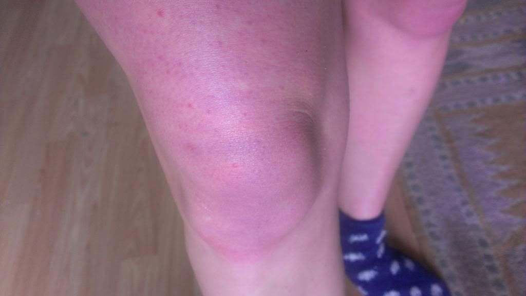 For a few years now, when I stand my thighs turn almost purple/red, and they get spots along